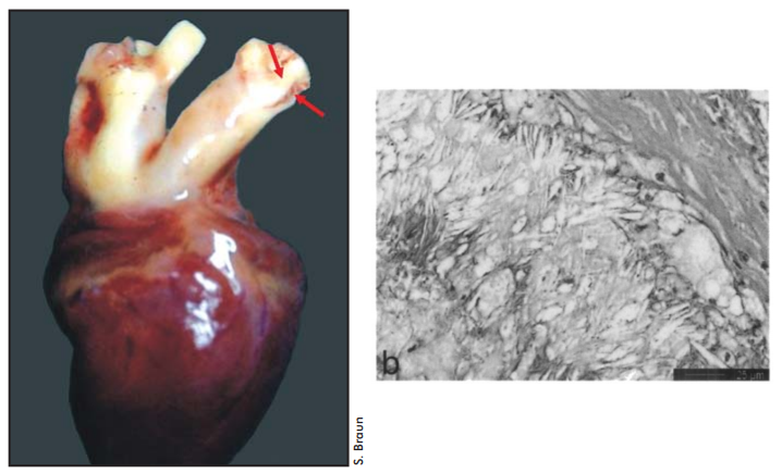 The avian heart may look healthy macroscopically but still be suffering from fatty buildup. While wing trimming is not the only cause of heart disease, the inability to fly and exercise normally works against heart health.
